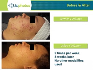 celluma-pro-acne-before-after