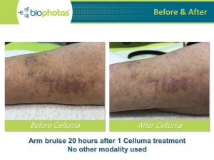 celluma-pro-wound-healing-before-after